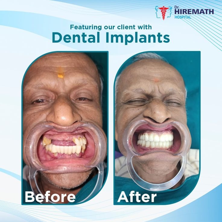 Patient Before and After of full mouth dental implant surgery by Dr. Vishwannath Hiremath, Bangalore